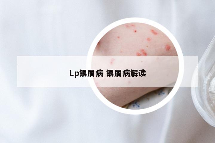 Lp银屑病 银屑病解读