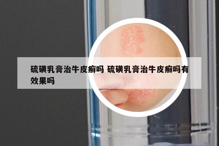 硫磺乳膏治牛皮癣吗 硫磺乳膏治牛皮癣吗有效果吗