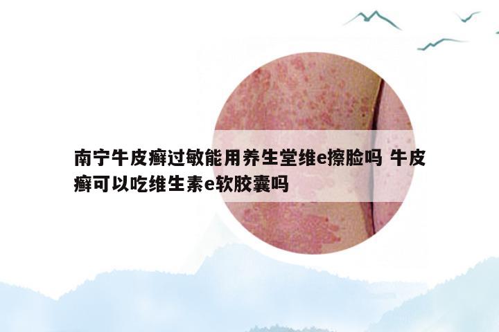 南宁牛皮癣过敏能用养生堂维e擦脸吗 牛皮癣可以吃维生素e软胶囊吗