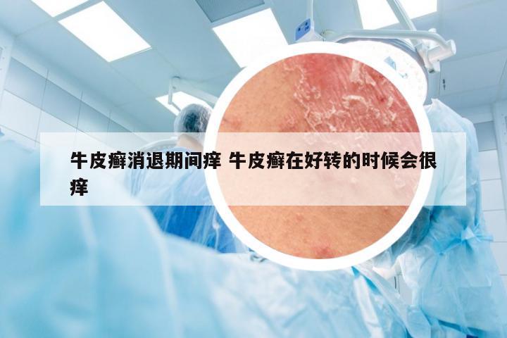 牛皮癣消退期间痒 牛皮癣在好转的时候会很痒