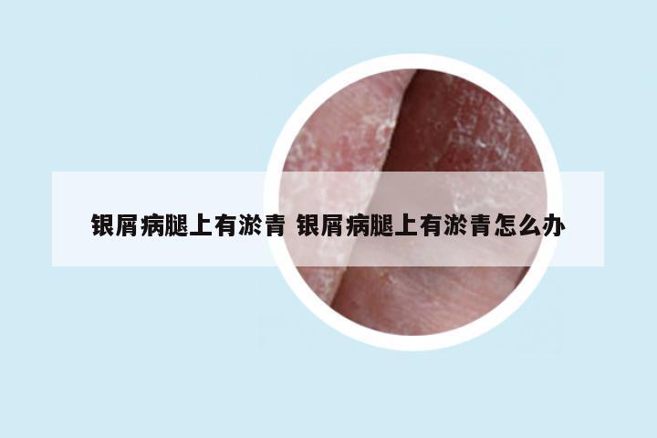 银屑病腿上有淤青 银屑病腿上有淤青怎么办