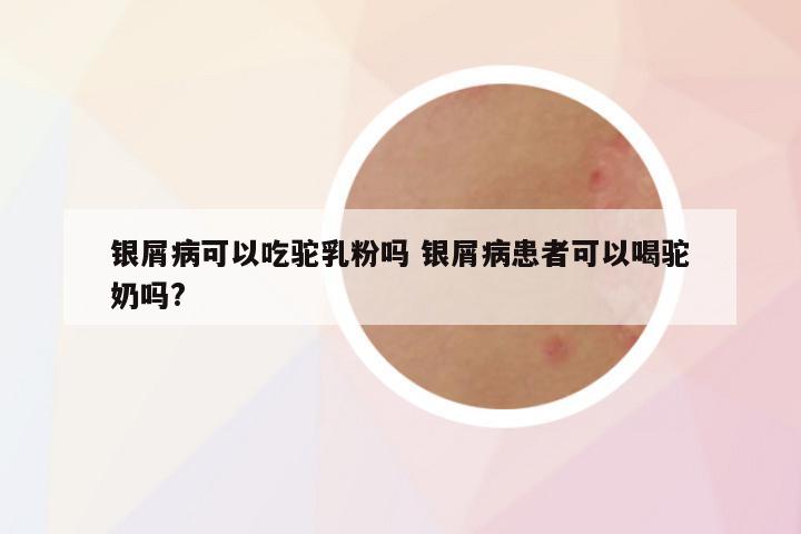 银屑病可以吃驼乳粉吗 银屑病患者可以喝驼奶吗?