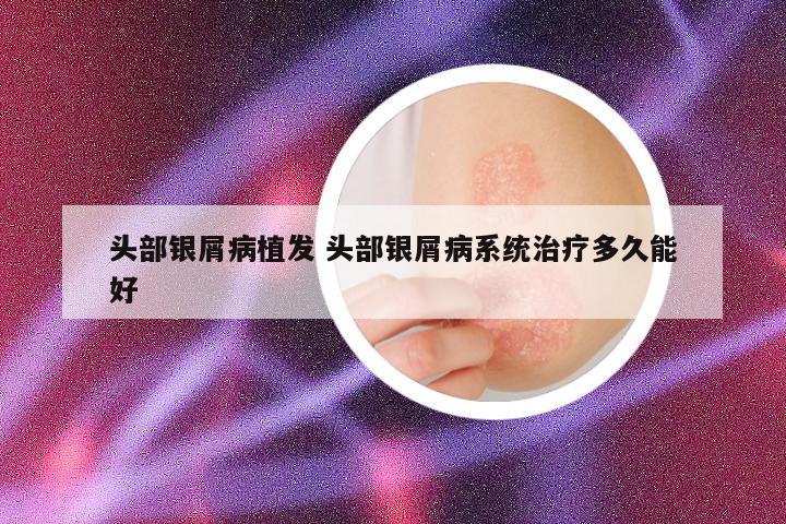 头部银屑病植发 头部银屑病系统治疗多久能好