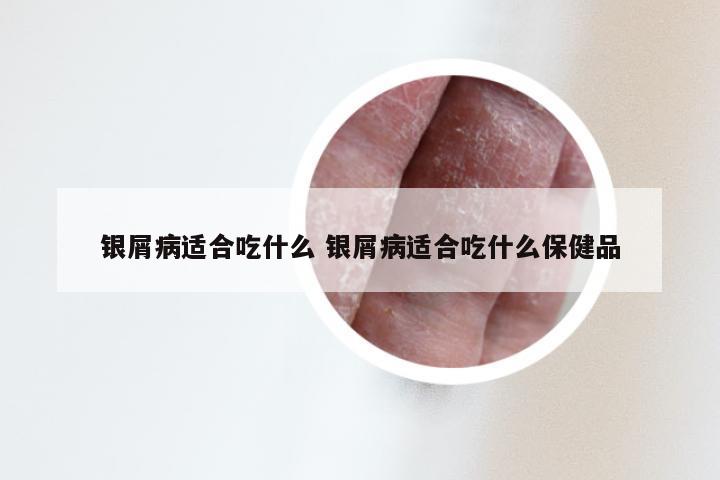 银屑病适合吃什么 银屑病适合吃什么保健品