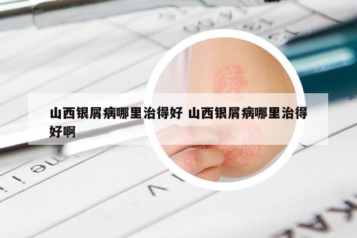 山西银屑病哪里治得好 山西银屑病哪里治得好啊