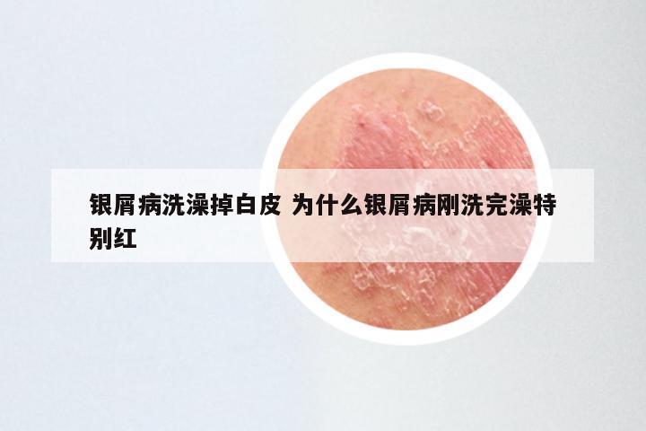 银屑病洗澡掉白皮 为什么银屑病刚洗完澡特别红
