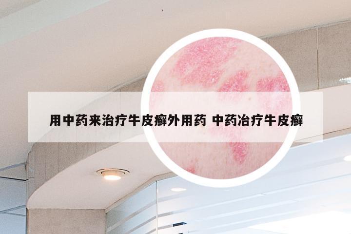 用中药来治疗牛皮癣外用药 中药冶疗牛皮癣