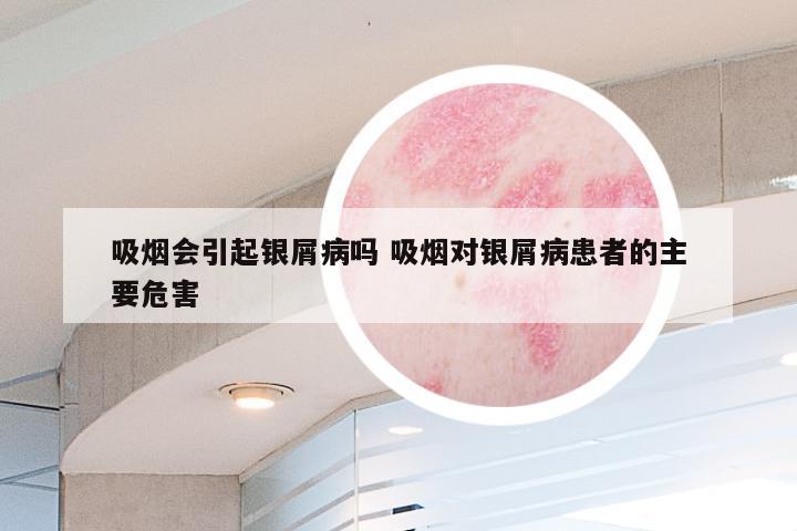 吸烟会引起银屑病吗 吸烟对银屑病患者的主要危害
