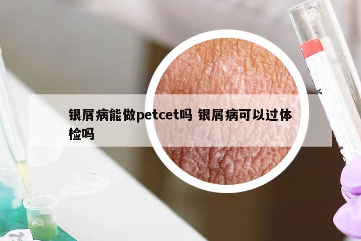银屑病能做petcet吗 银屑病可以过体检吗