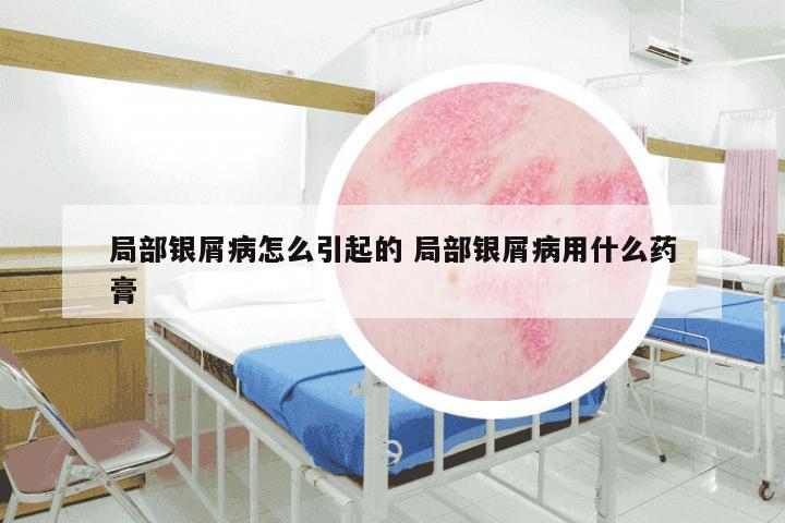 局部银屑病怎么引起的 局部银屑病用什么药膏