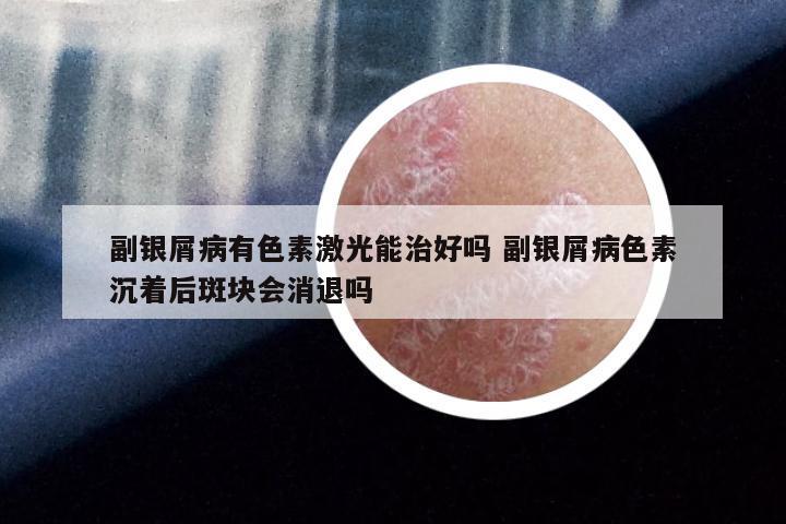 副银屑病有色素激光能治好吗 副银屑病色素沉着后斑块会消退吗