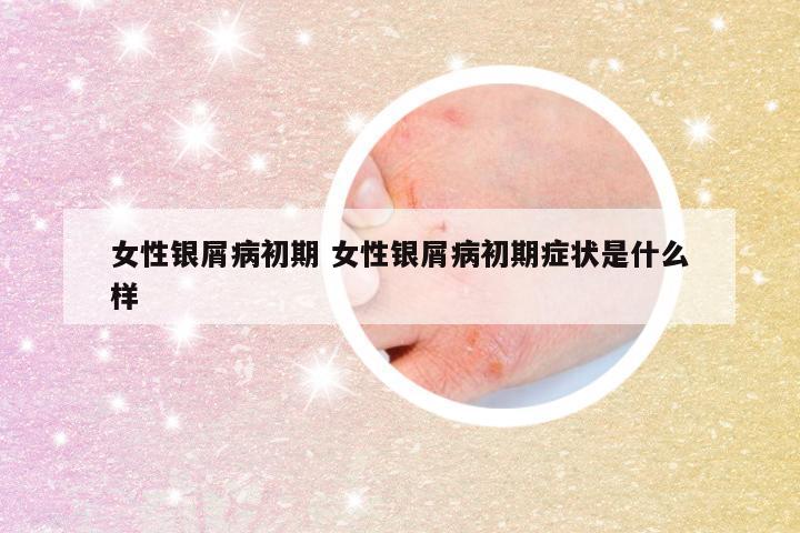 女性银屑病初期 女性银屑病初期症状是什么样