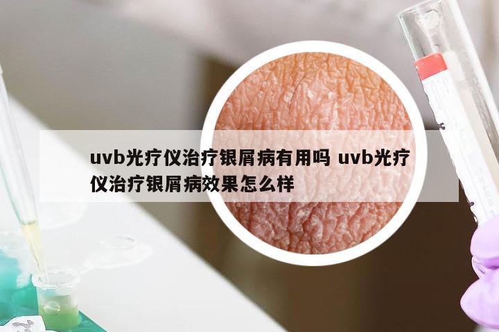 uvb光疗仪治疗银屑病有用吗 uvb光疗仪治疗银屑病效果怎么样
