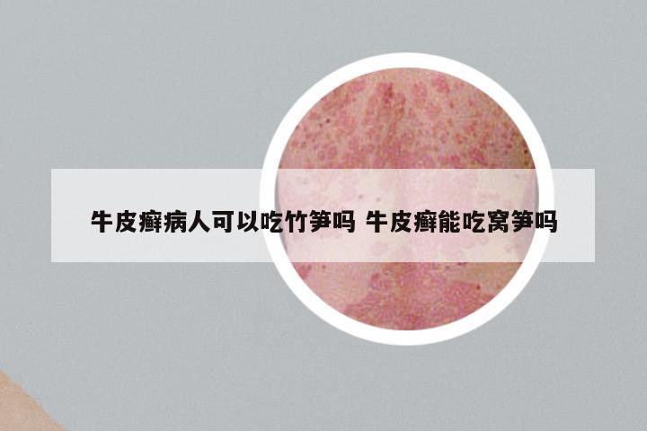 牛皮癣病人可以吃竹笋吗 牛皮癣能吃窝笋吗