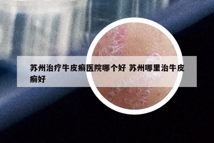 苏州治疗牛皮癣医院哪个好 苏州哪里治牛皮癣好
