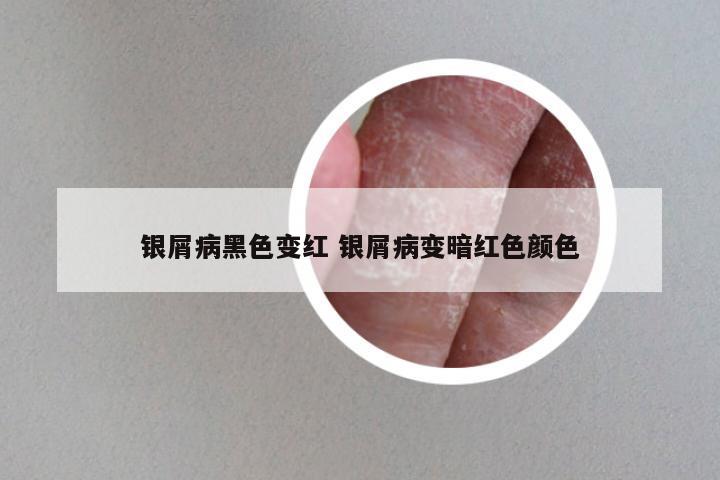 银屑病黑色变红 银屑病变暗红色颜色