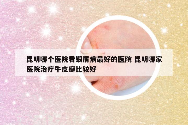 昆明哪个医院看银屑病最好的医院 昆明哪家医院治疗牛皮癣比较好