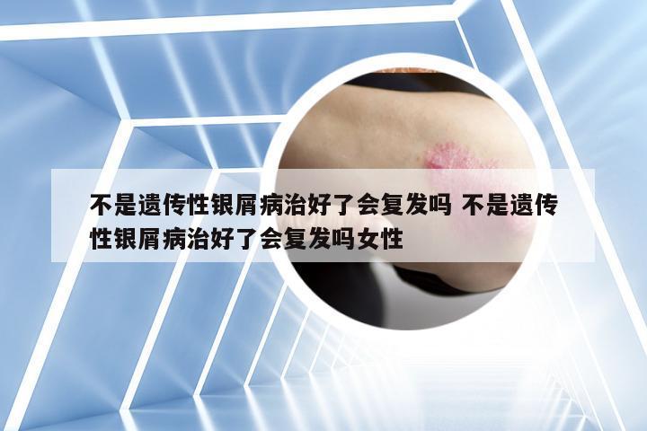 不是遗传性银屑病治好了会复发吗 不是遗传性银屑病治好了会复发吗女性