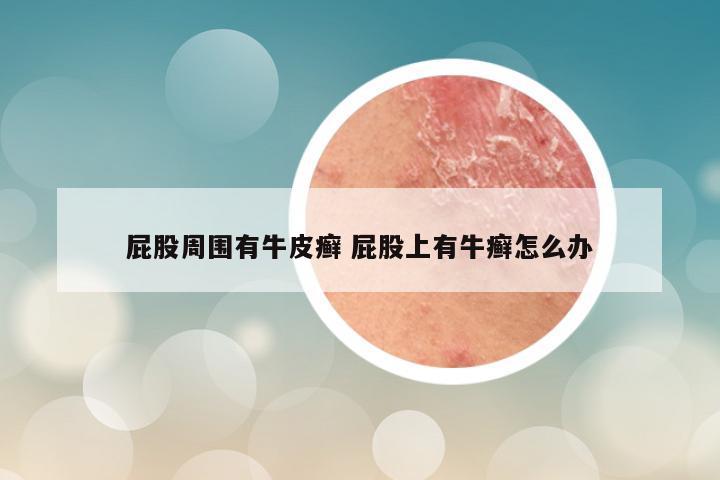 屁股周围有牛皮癣 屁股上有牛癣怎么办