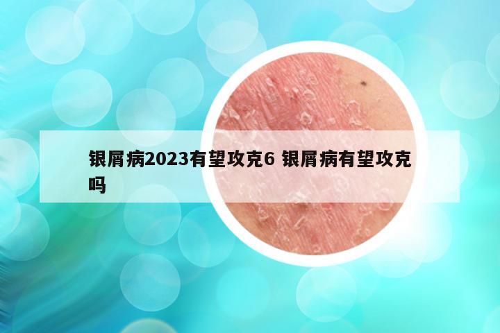 银屑病2023有望攻克6 银屑病有望攻克吗