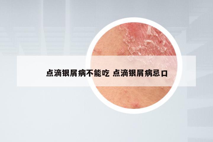 点滴银屑病不能吃 点滴银屑病忌口
