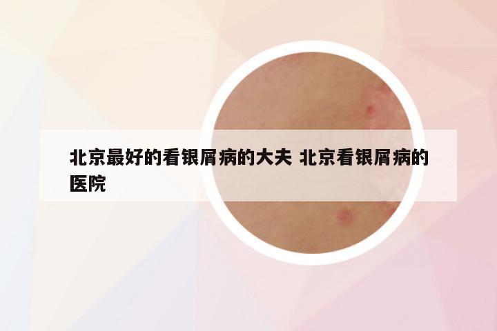北京最好的看银屑病的大夫 北京看银屑病的医院