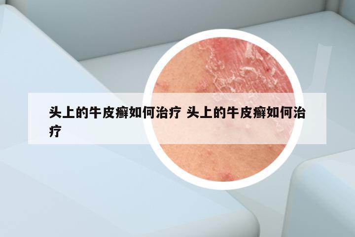 头上的牛皮癣如何治疗 头上的牛皮癣如何治疗
