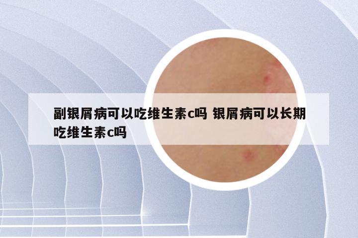 副银屑病可以吃维生素c吗 银屑病可以长期吃维生素c吗