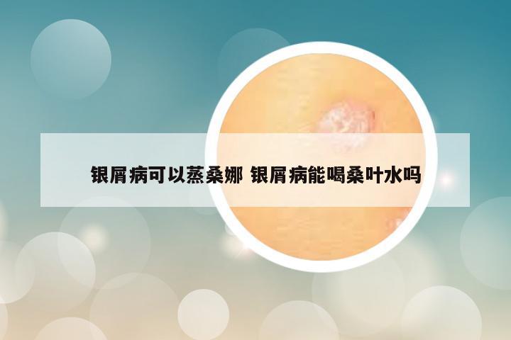 银屑病可以蒸桑娜 银屑病能喝桑叶水吗