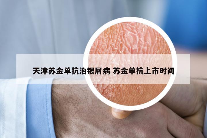 天津苏金单抗治银屑病 苏金单抗上市时间