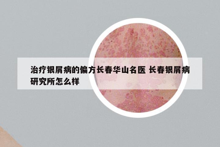治疗银屑病的偏方长春华山名医 长春银屑病研究所怎么样