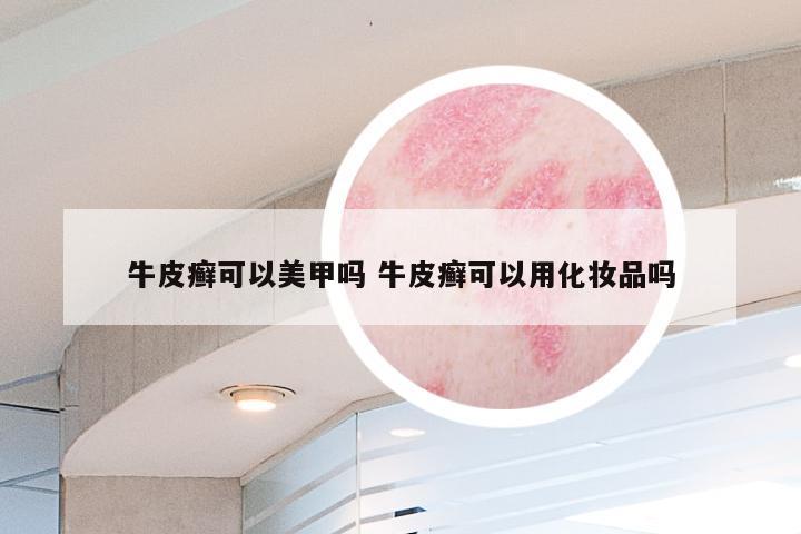 牛皮癣可以美甲吗 牛皮癣可以用化妆品吗