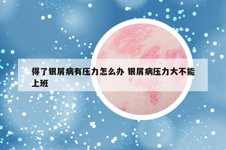 得了银屑病有压力怎么办 银屑病压力大不能上班
