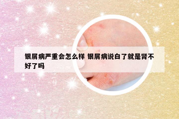 银屑病严重会怎么样 银屑病说白了就是肾不好了吗