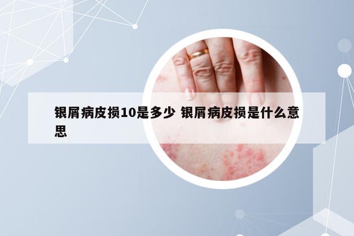 银屑病皮损10是多少 银屑病皮损是什么意思