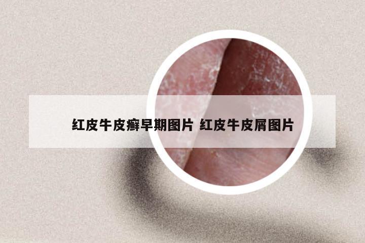 红皮牛皮癣早期图片 红皮牛皮屑图片