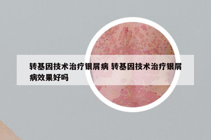转基因技术治疗银屑病 转基因技术治疗银屑病效果好吗