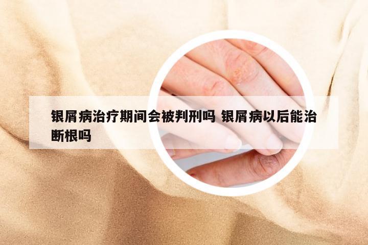 银屑病治疗期间会被判刑吗 银屑病以后能治断根吗