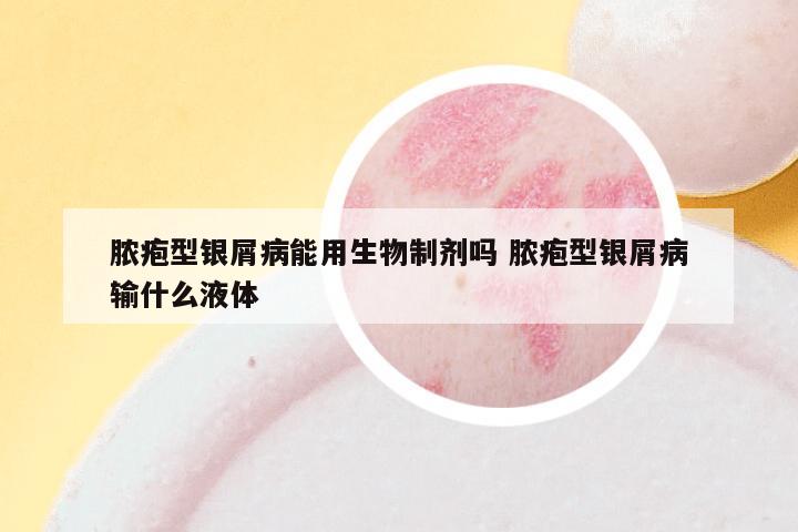 脓疱型银屑病能用生物制剂吗 脓疱型银屑病输什么液体
