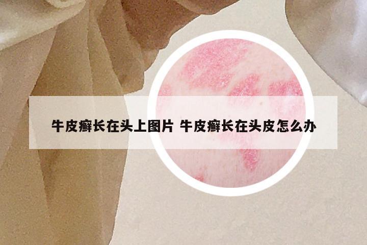 牛皮癣长在头上图片 牛皮癣长在头皮怎么办