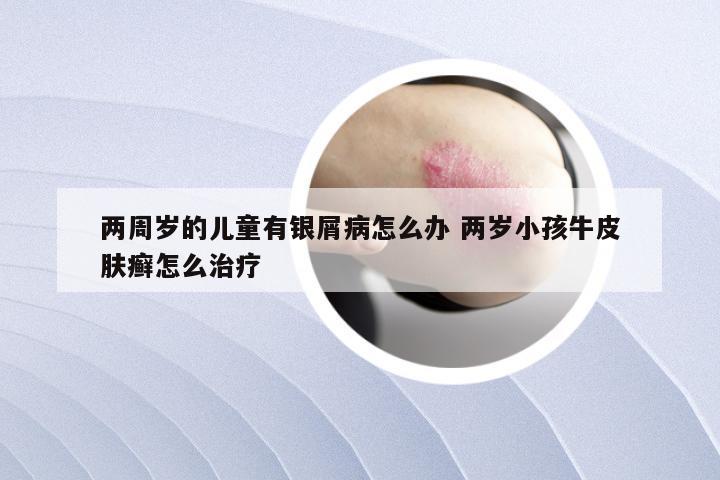 两周岁的儿童有银屑病怎么办 两岁小孩牛皮肤癣怎么治疗