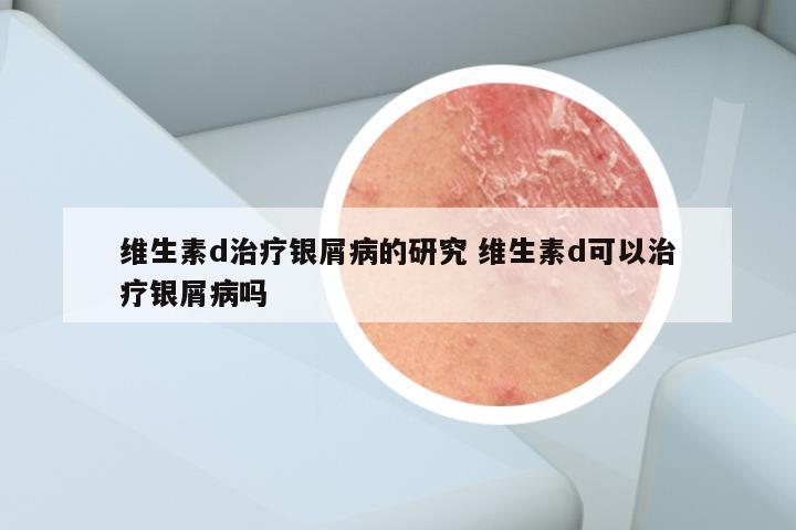 维生素d治疗银屑病的研究 维生素d可以治疗银屑病吗