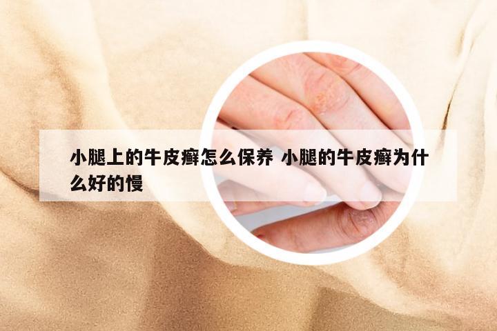 小腿上的牛皮癣怎么保养 小腿的牛皮癣为什么好的慢