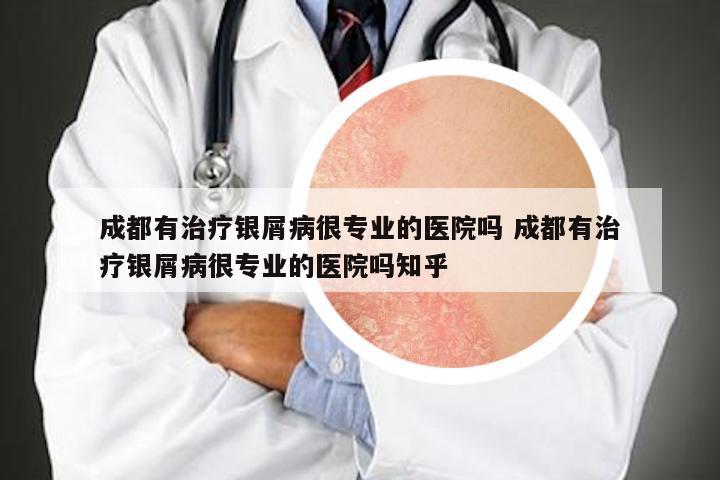 成都有治疗银屑病很专业的医院吗 成都有治疗银屑病很专业的医院吗知乎
