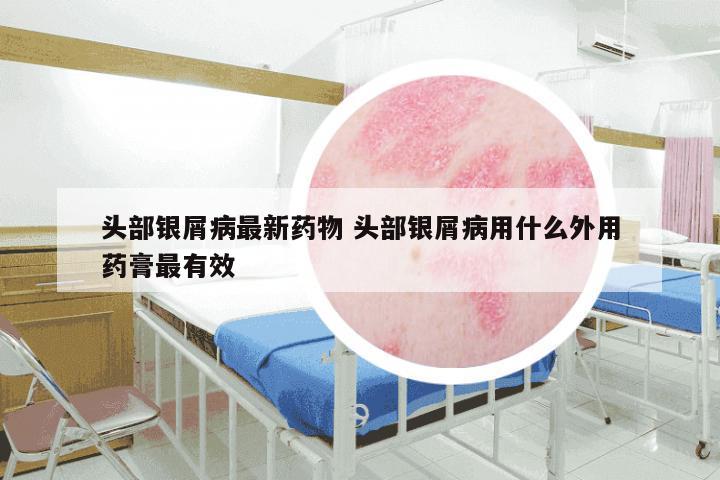 头部银屑病最新药物 头部银屑病用什么外用药膏最有效