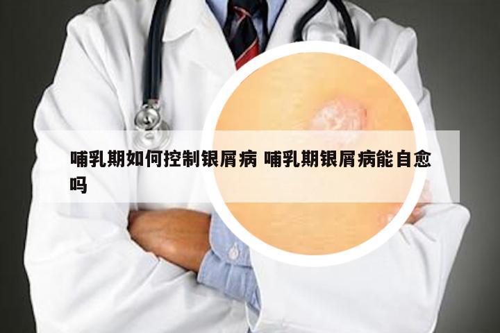 哺乳期如何控制银屑病 哺乳期银屑病能自愈吗