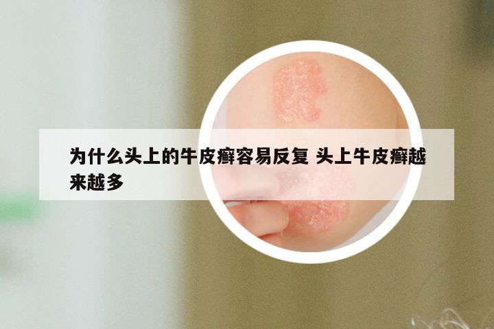 为什么头上的牛皮癣容易反复 头上牛皮癣越来越多