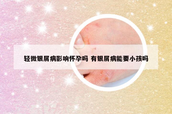 轻微银屑病影响怀孕吗 有银屑病能要小孩吗
