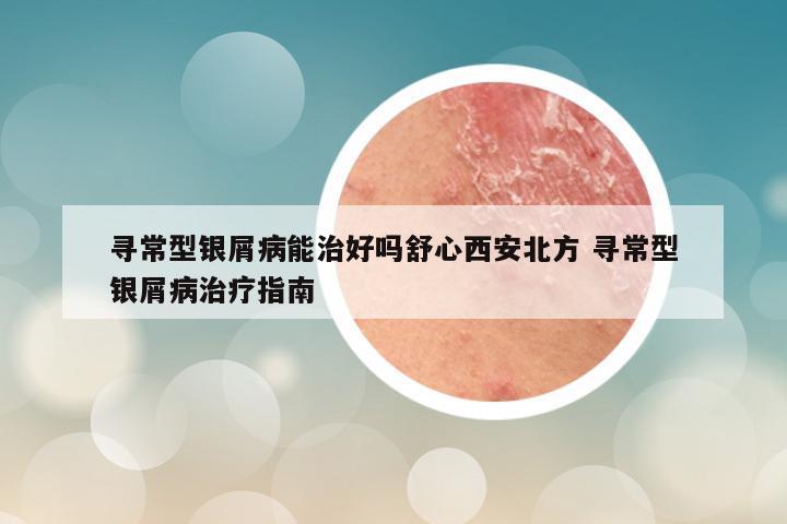 寻常型银屑病能治好吗舒心西安北方 寻常型银屑病治疗指南
