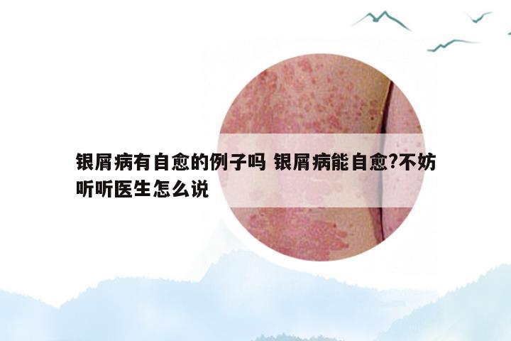 银屑病有自愈的例子吗 银屑病能自愈?不妨听听医生怎么说